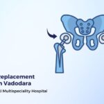 Best Hip Replacement Surgeon in Vadodara